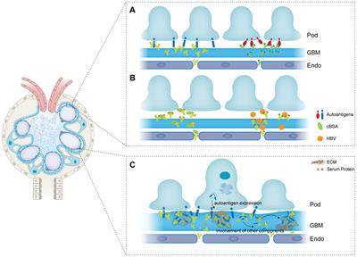 The fate of immune complexes in membranous nephropathy